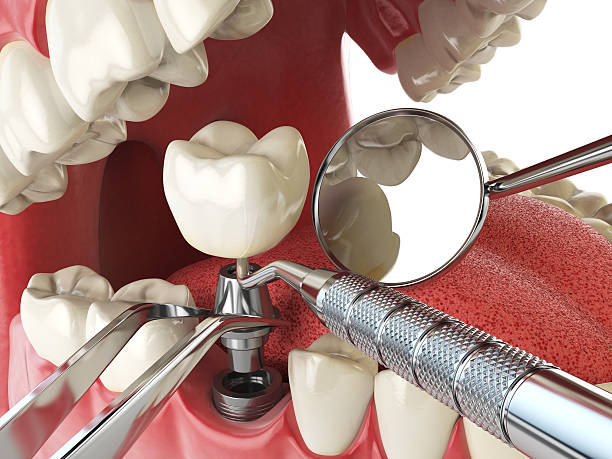 Best Broken or Chipped Tooth Repair in Hawkinsville, GA